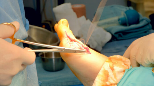hallux valgus